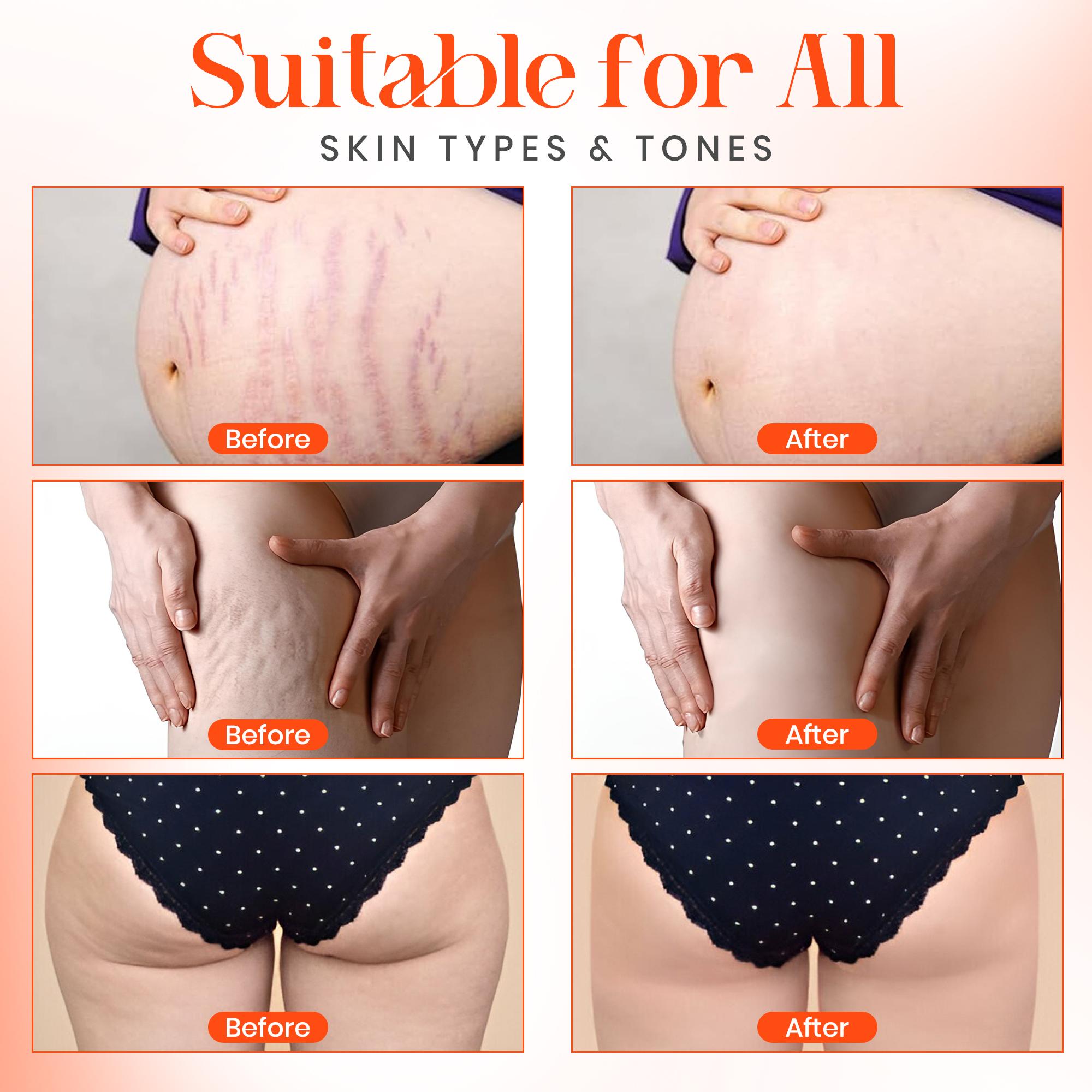 Stretch mark remover oil