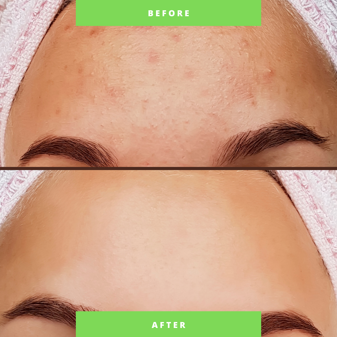 Organic Two-Step Anti-Acne Facial System = For WOMEN